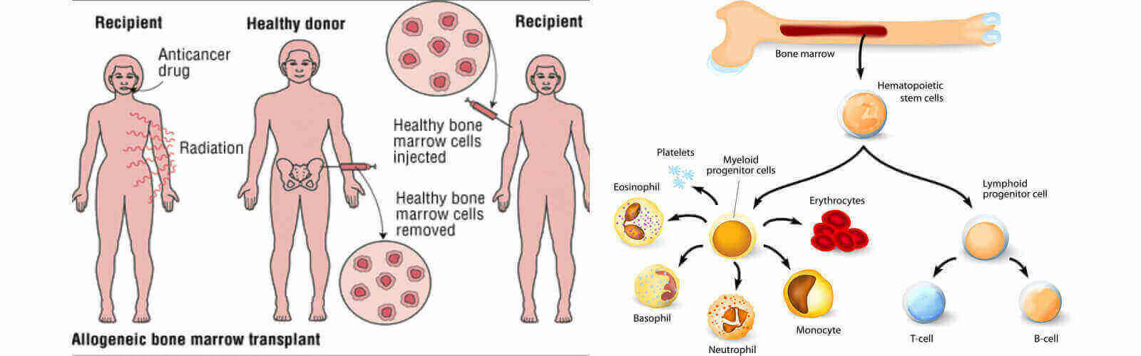 Different Types of Bone Marrow Transplant
