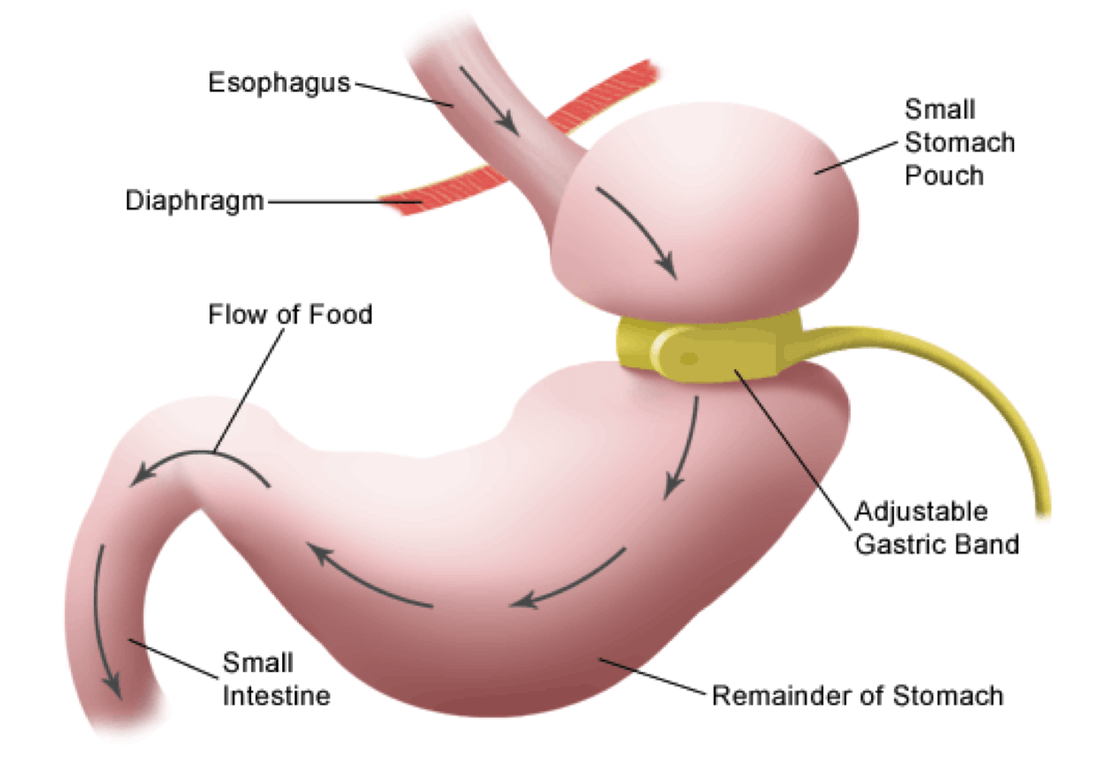 Bariatric Surgery Cost In India