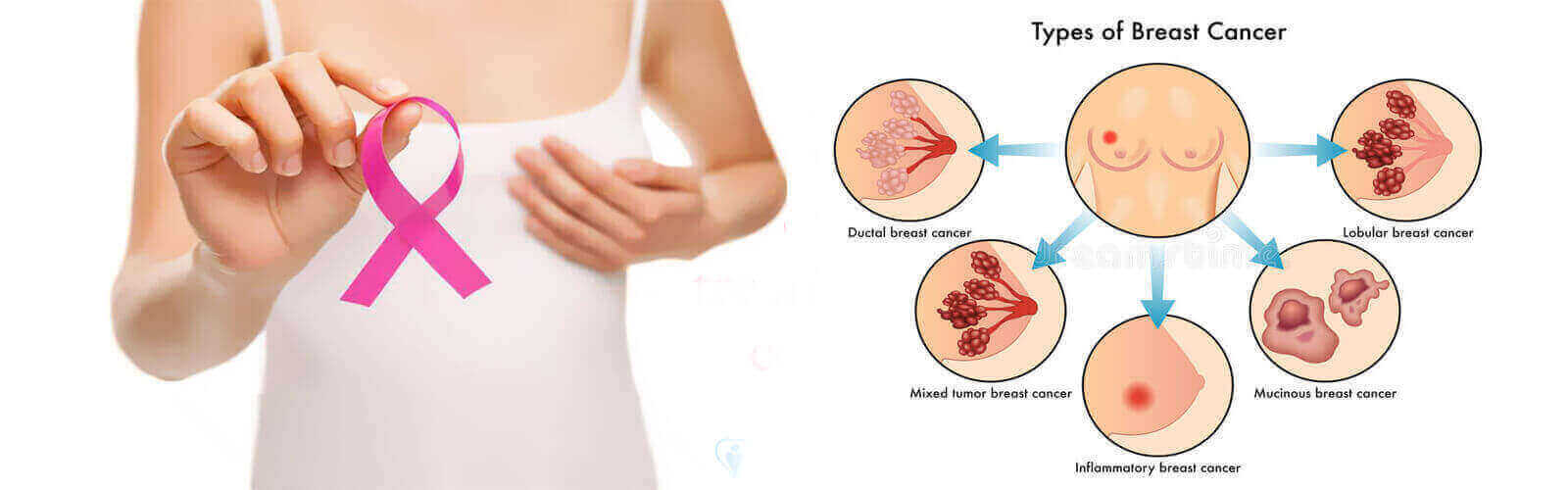 Breast Cancer Treatment in Canada