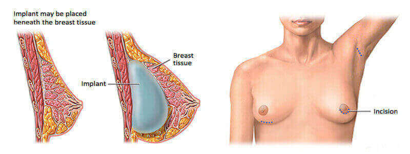 Breast Implant Surgery in Liberia