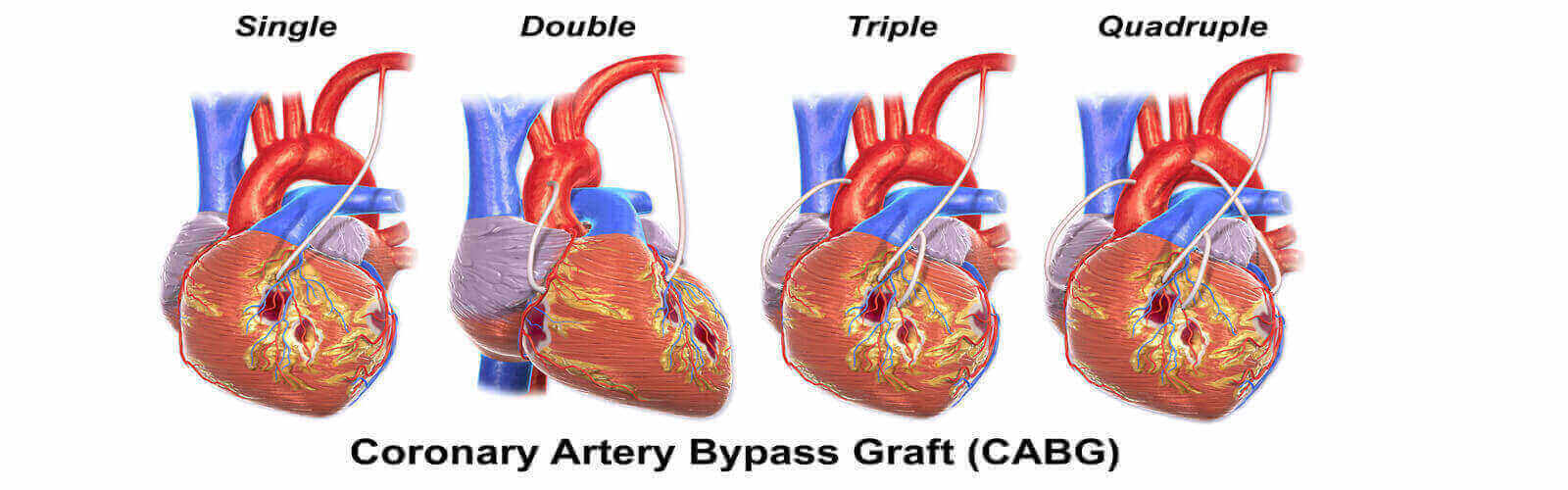 Coronary Artery Bypass Graft in India
