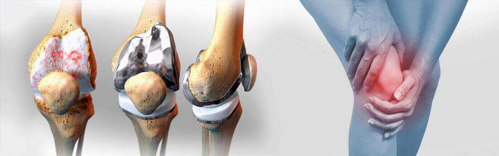 Knee Replacement Surgery in Uae