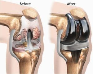 Knee Surgery In India