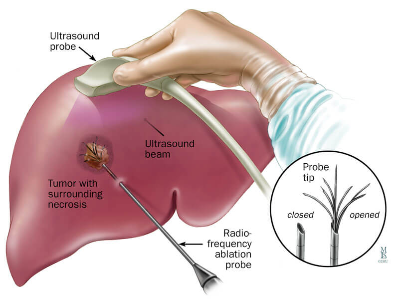 Four Stages Of Liver Cancer