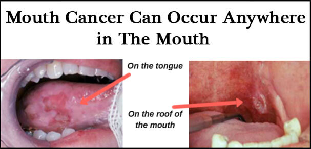 Symptoms To Identify Mouth Cancer
