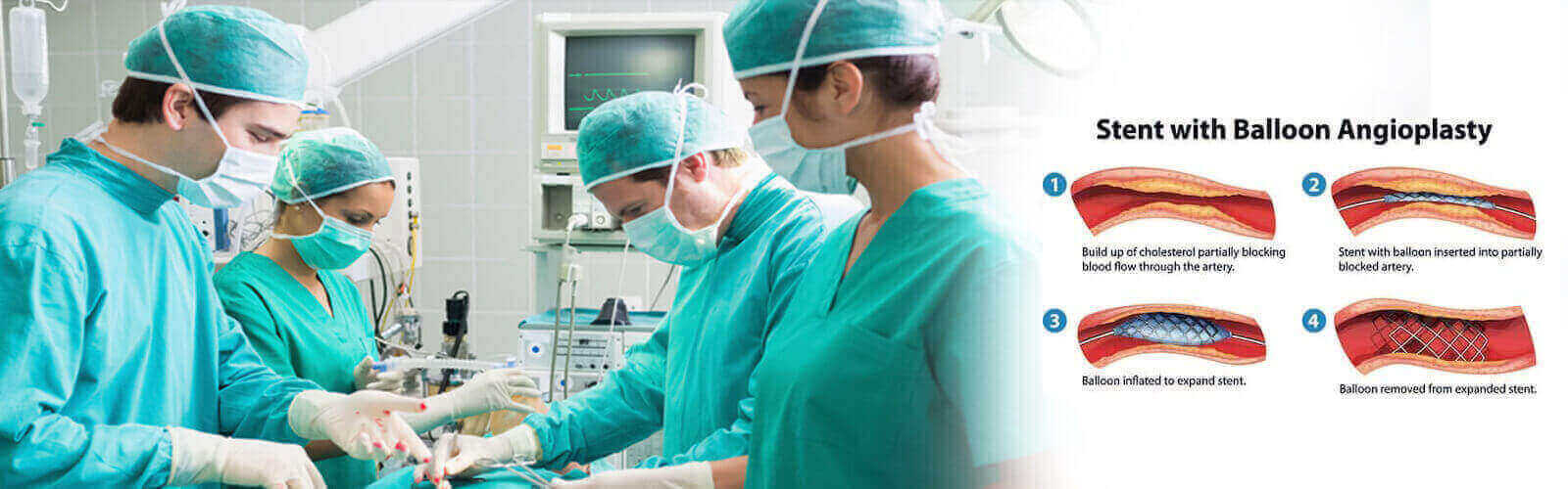 Angioplasty Surgery in Stoke-on-trent