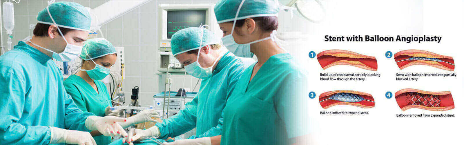 Angioplasty Surgery in Wigan