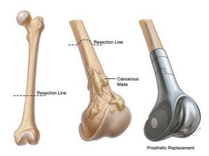 Bone Cancer Treatment in india