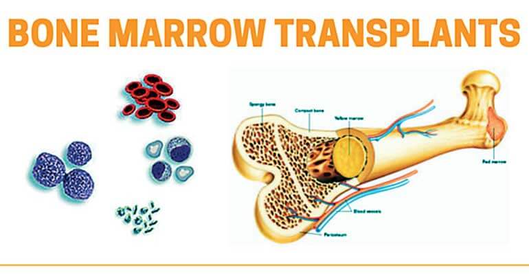 Bone Marrow Transplant Cost In India