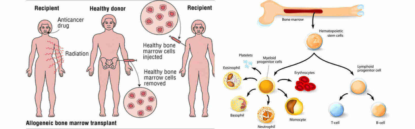Bone Marrow Transplant in Las Vegas