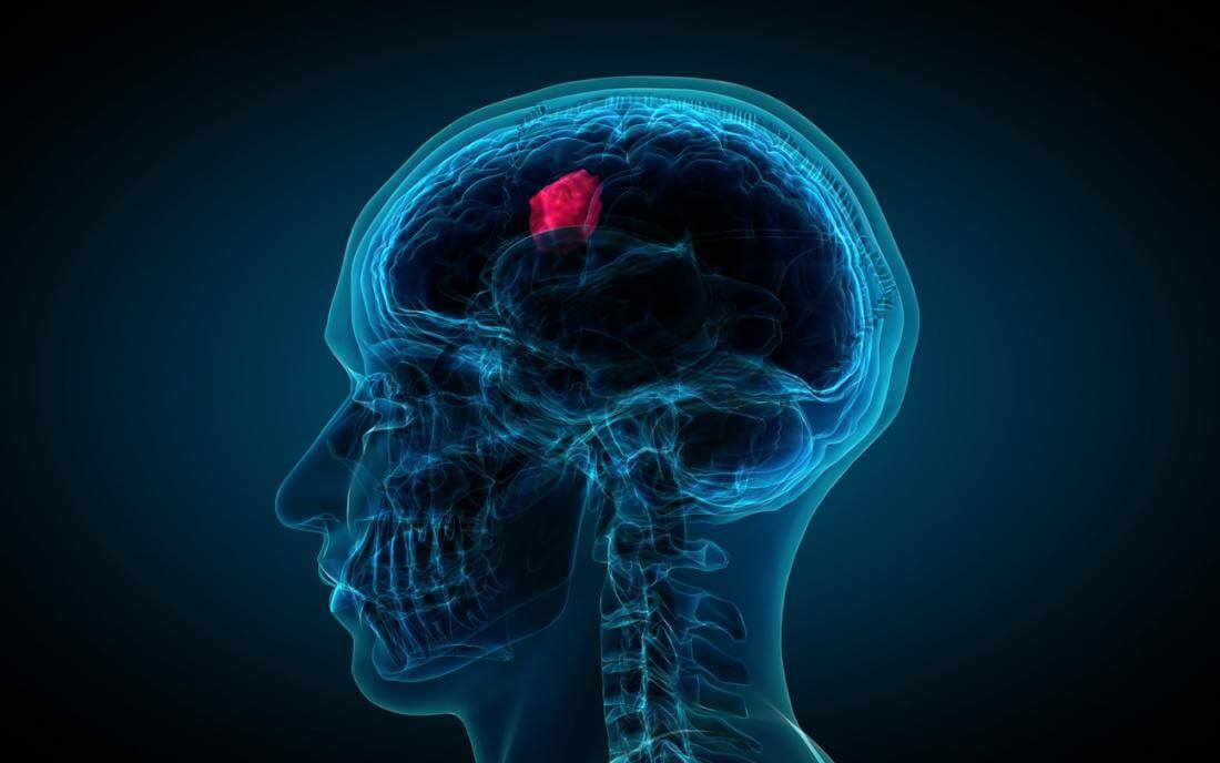Brain Tumor Treatment in india