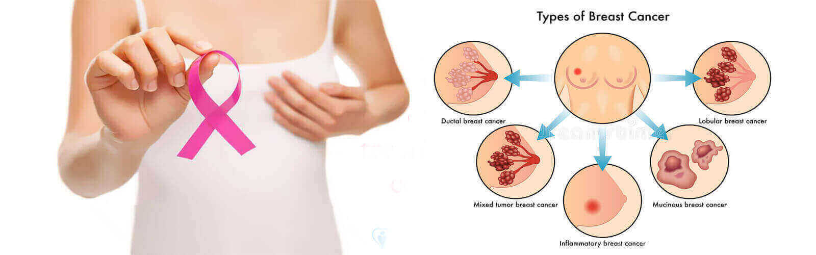 Breast Cancer Treatment in Hong Kong