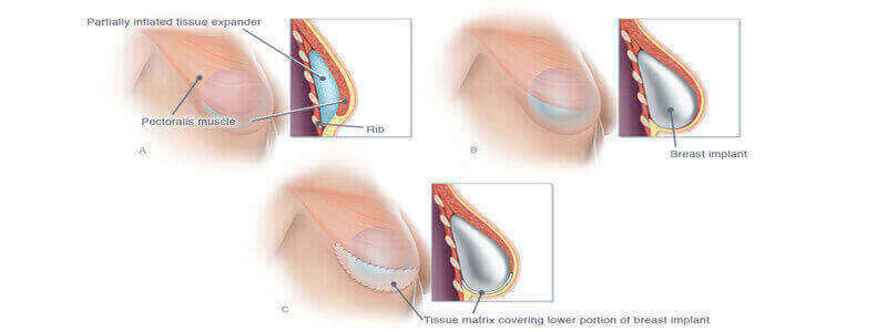 Breast Surgery in Colorado