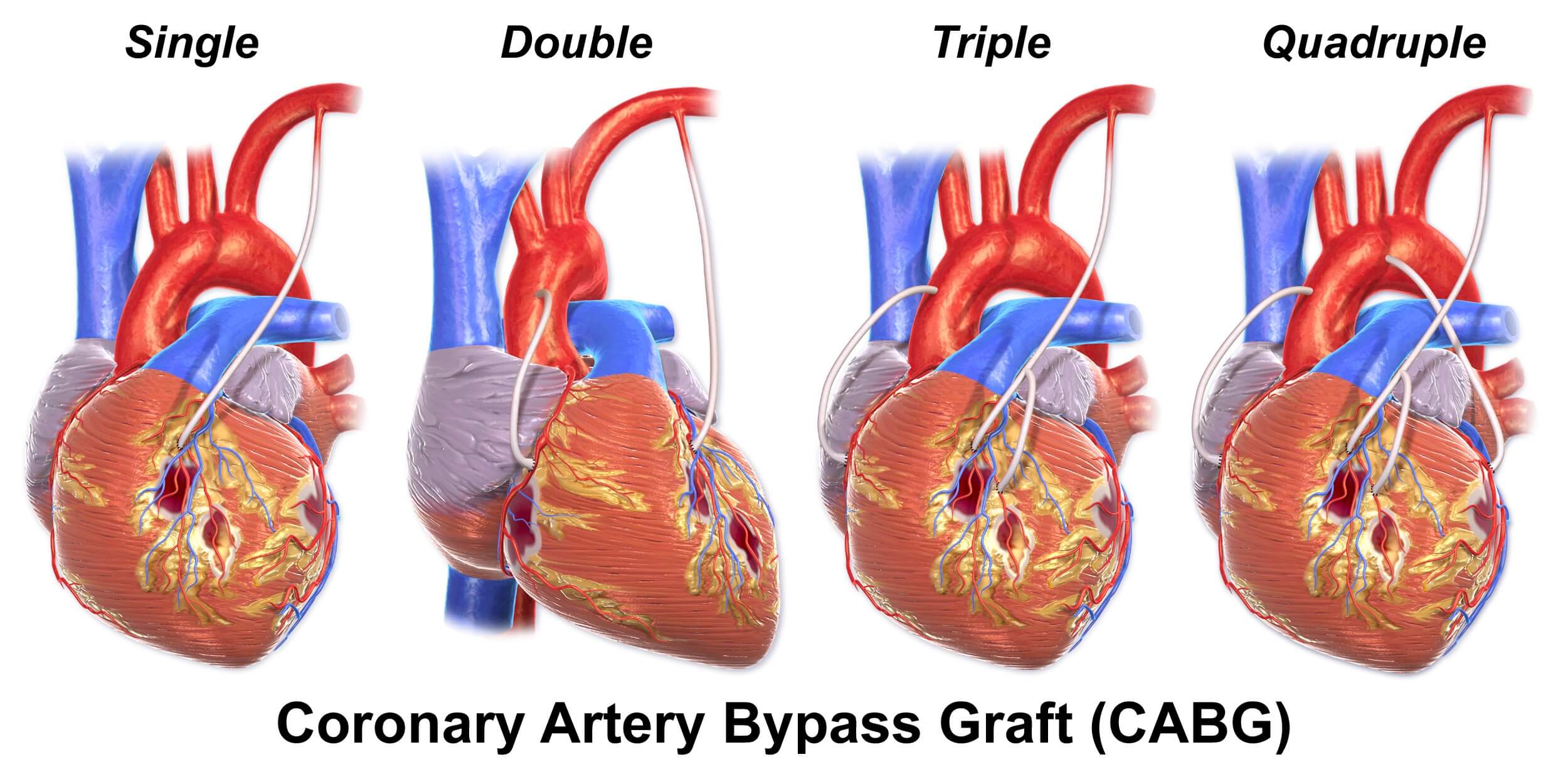 Bypass Surgery Cost In India