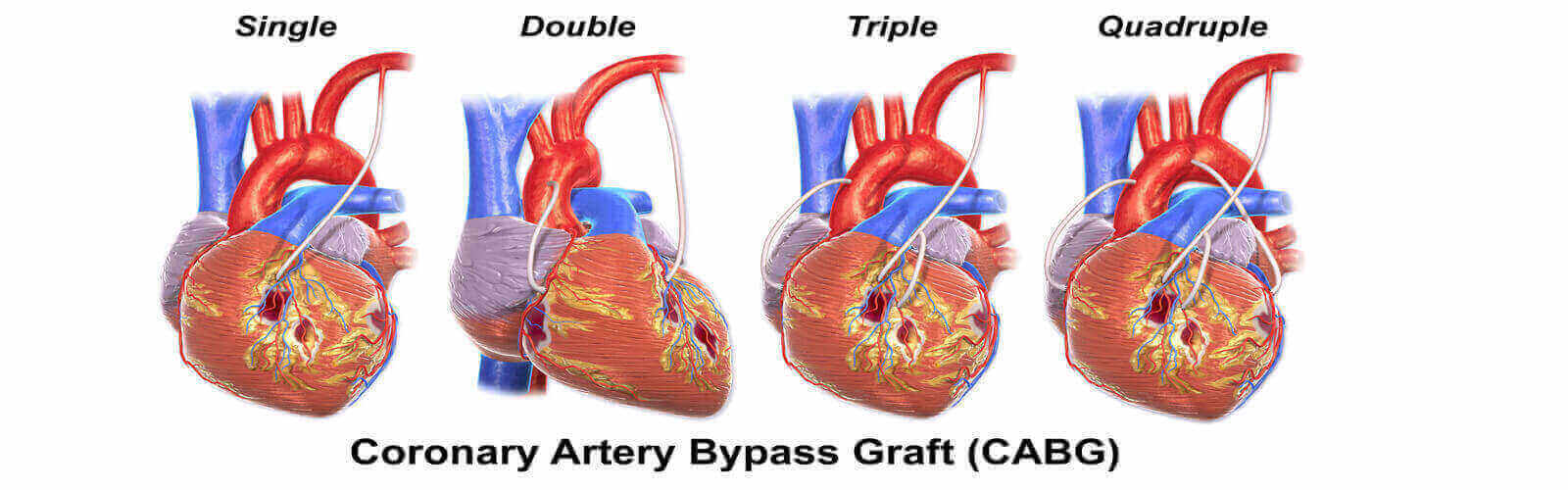 Coronary Artery Bypass Graft in Alaska