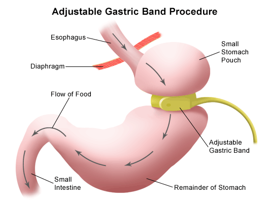 Gastric Band Surgery In India