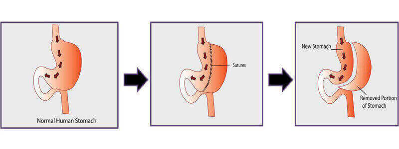 Gastric Sleeve Surgery in Las Vegas