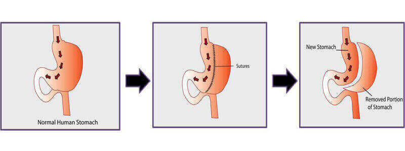 Gastric Sleeve Surgery in Bosnia And Herzegovina