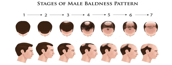 Hair Transplant Cost In India