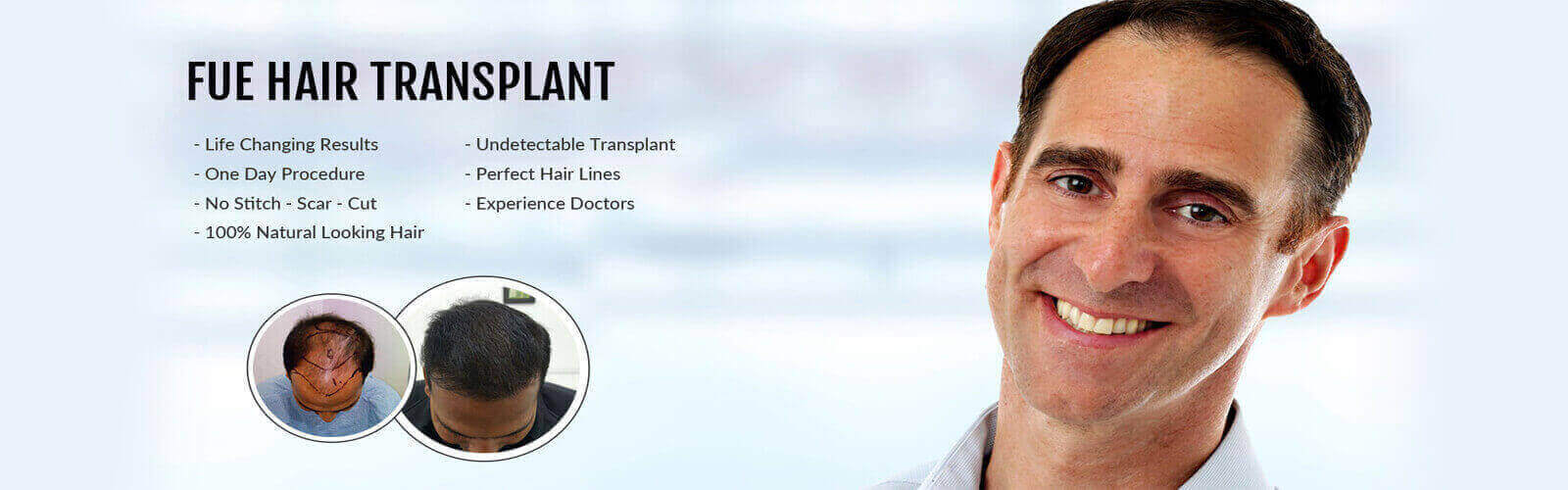 Hair Transplant in Bradford