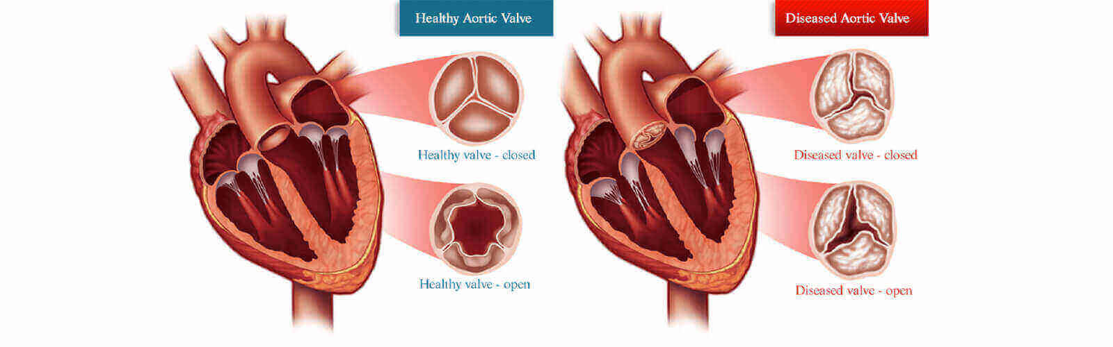 Heart Valve Replacement Surgery in Ipswich