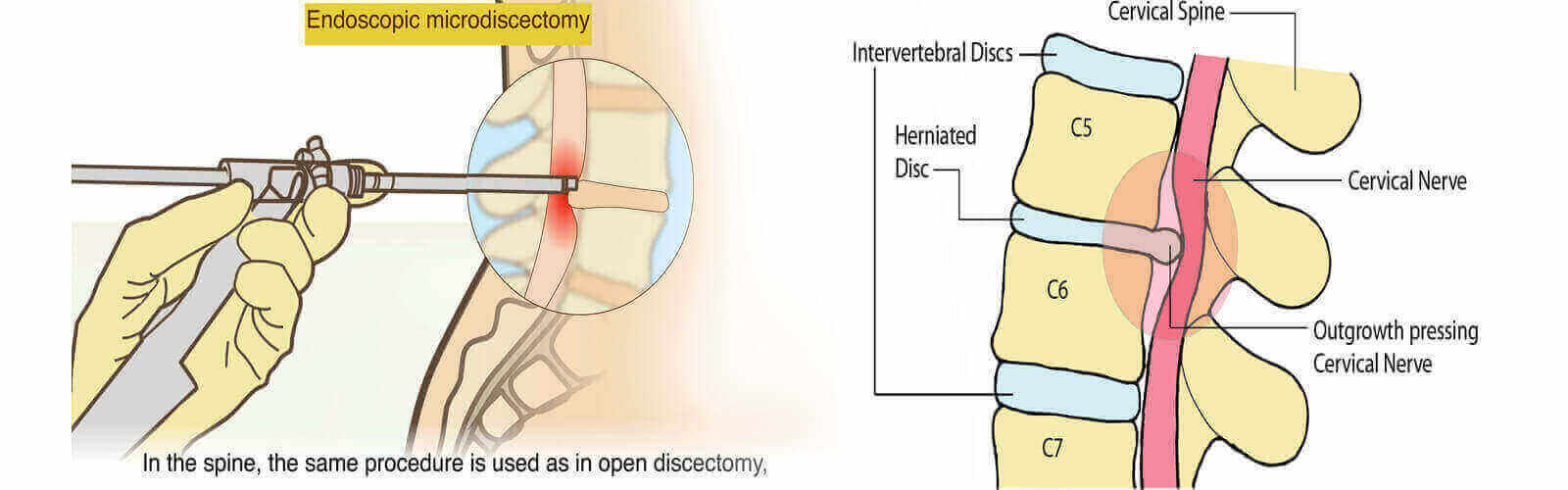 Herniated Disc Treatment in Las Vegas