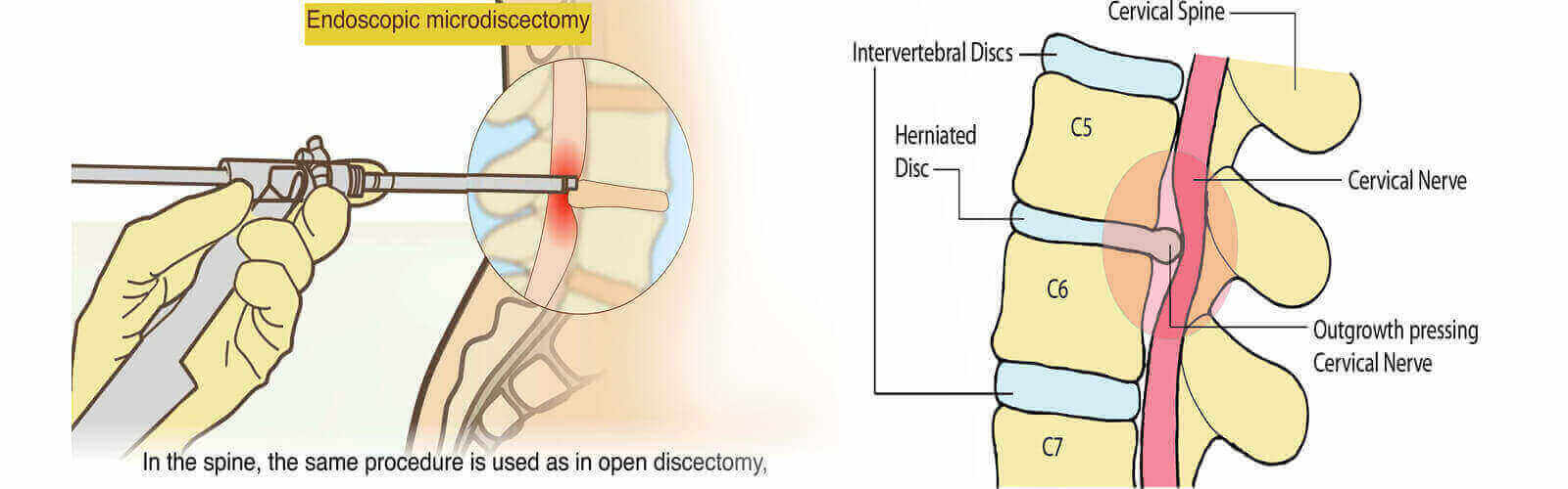 Herniated Disc Treatment in Guinea