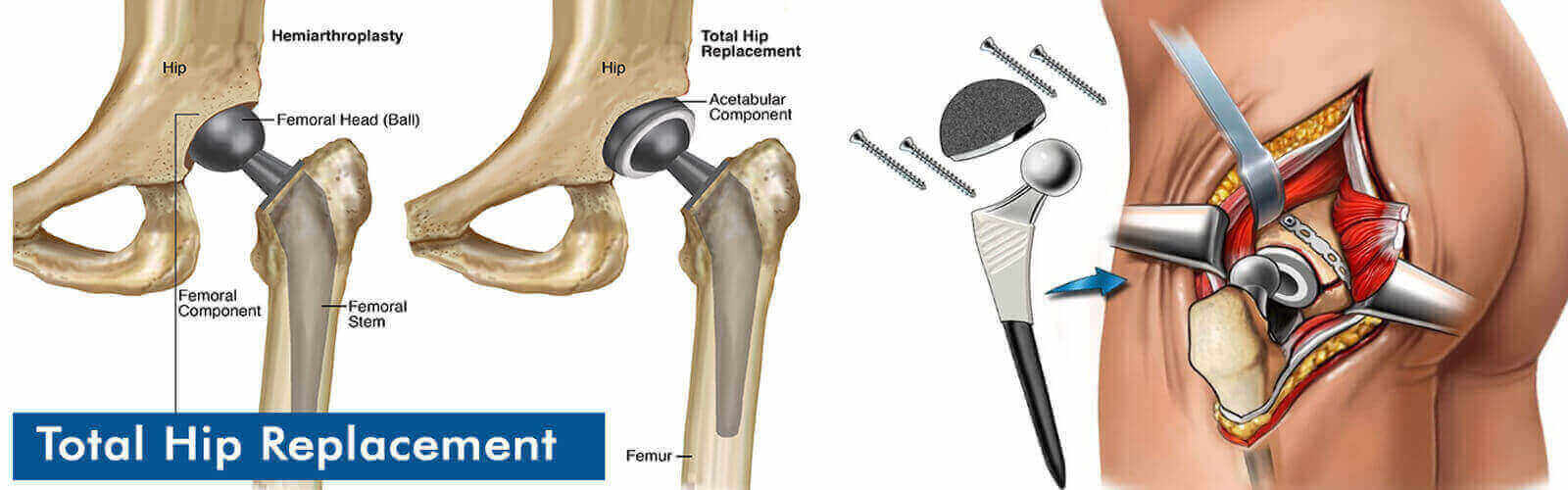 Hip Replacement Surgery Or Hip Resurfacing in Southampton