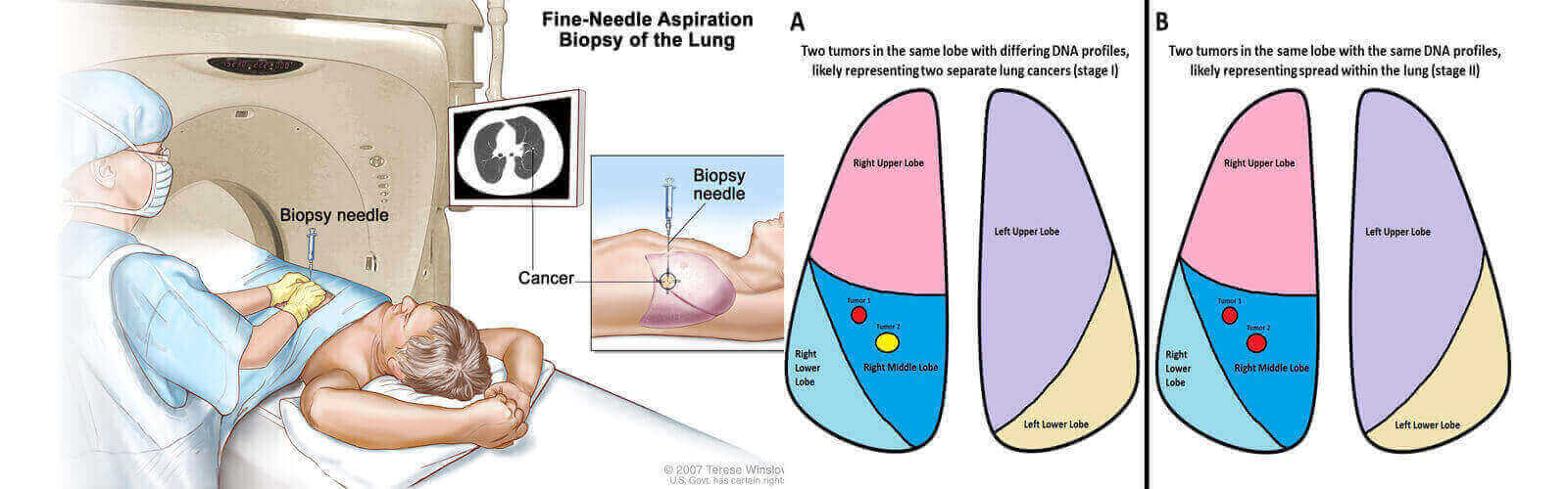 Lung Cancer Treatment in Seattle