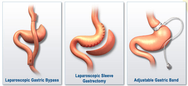 Obesity Surgery In India