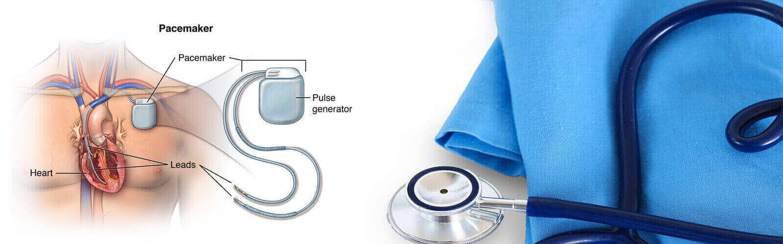 Pacemaker Surgery In India