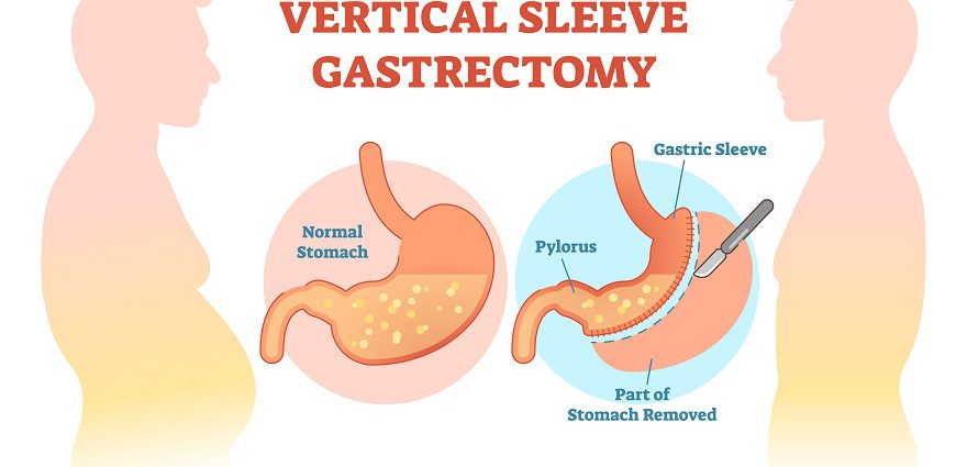 Sleeve Gastrectomy Surgery In India